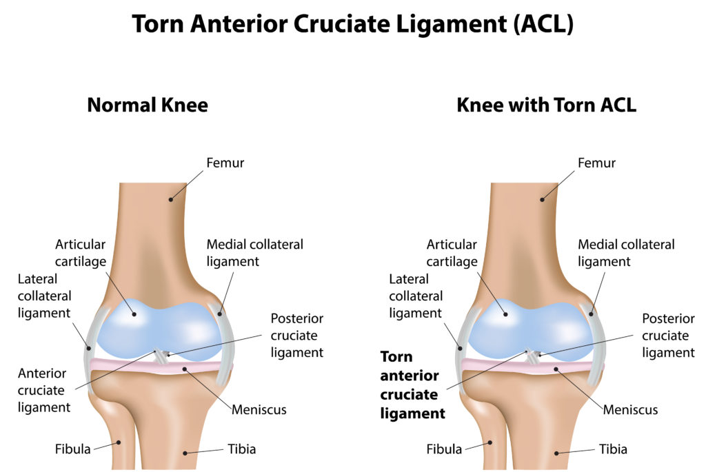 ACL Reconstruction Consultation with Dr. Jigar Desai