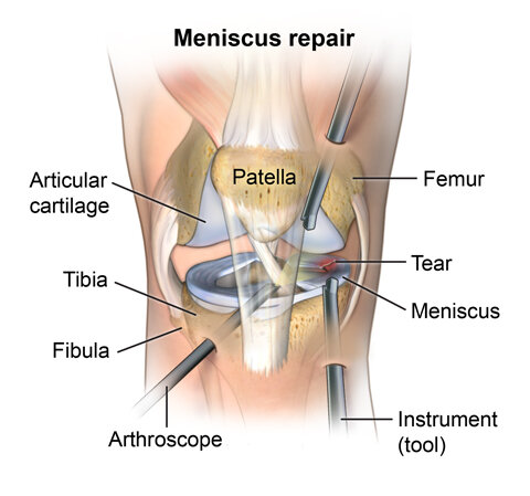 Meniscus Injury and Arthroscopy Repair