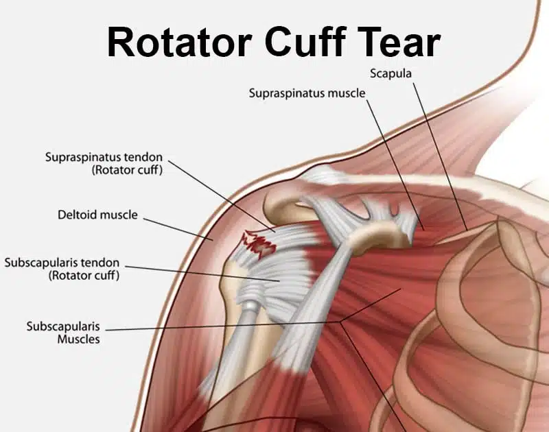 Rotator Cuff Tear Treatment and Recovery