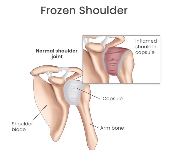 Frozen Shoulder Treatment by Dr. Jigar Desai