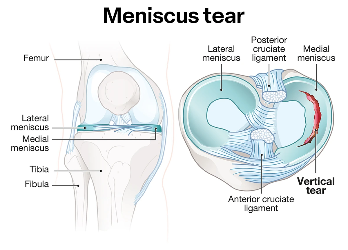 Knee Arthroscopy by Dr. Jigar Desai