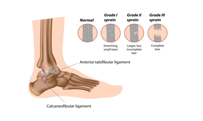 Ligament Injury Treatment