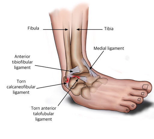 Ligament Injury Treatment by Dr. Jigar Desai