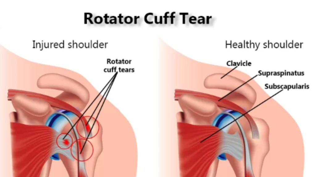 Rotator Cuff Tear Treatment by Dr. Jigar Desai