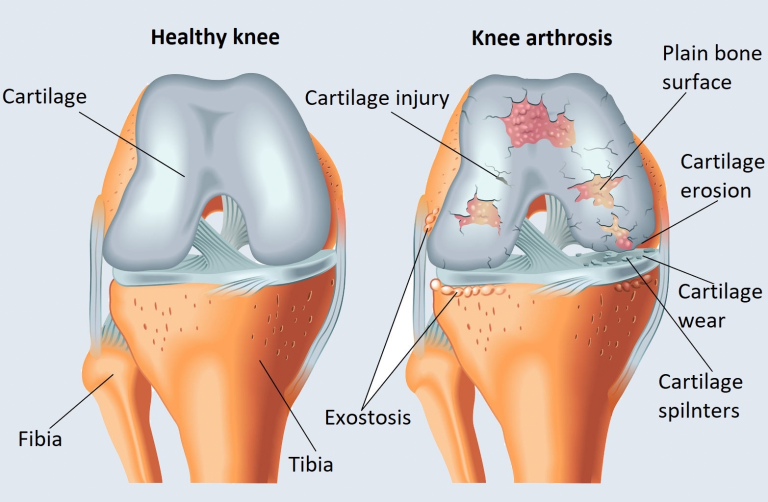 Chondromalacia Patellae