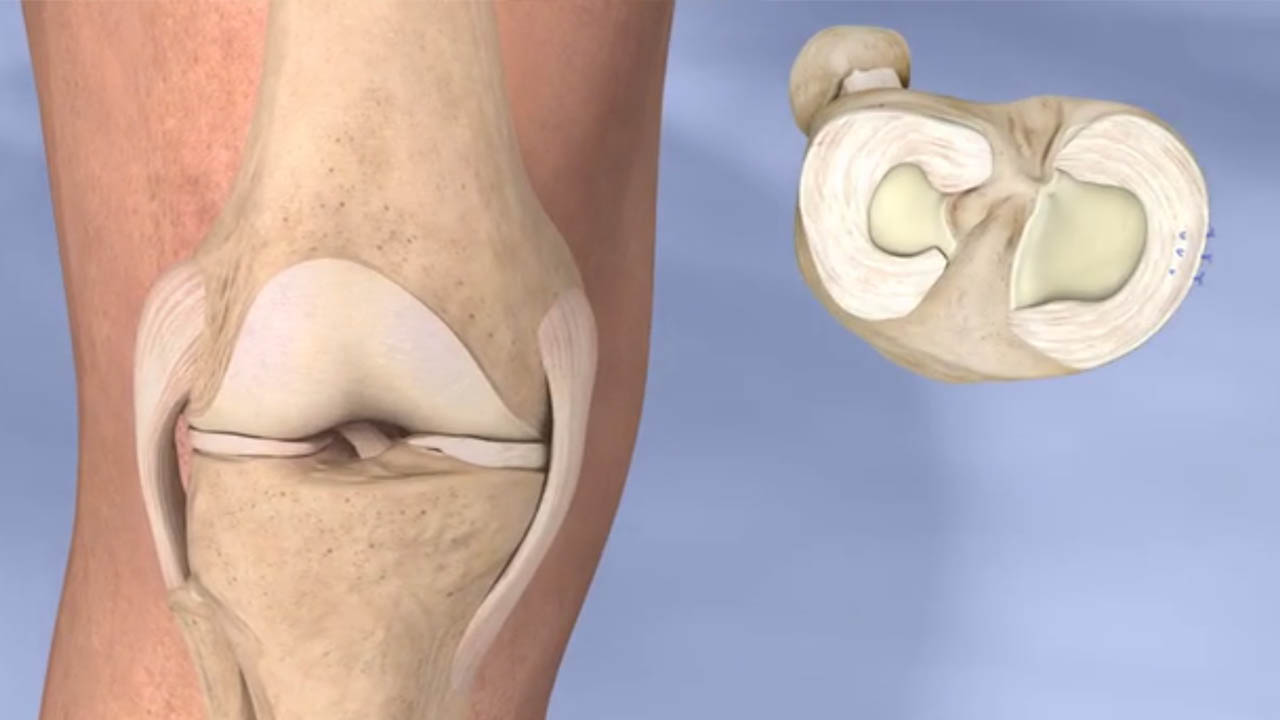 Knee Arthroscopy