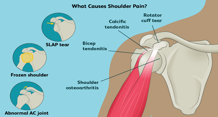 Shoulder Pain Treatment by Dr. Jigar Desai