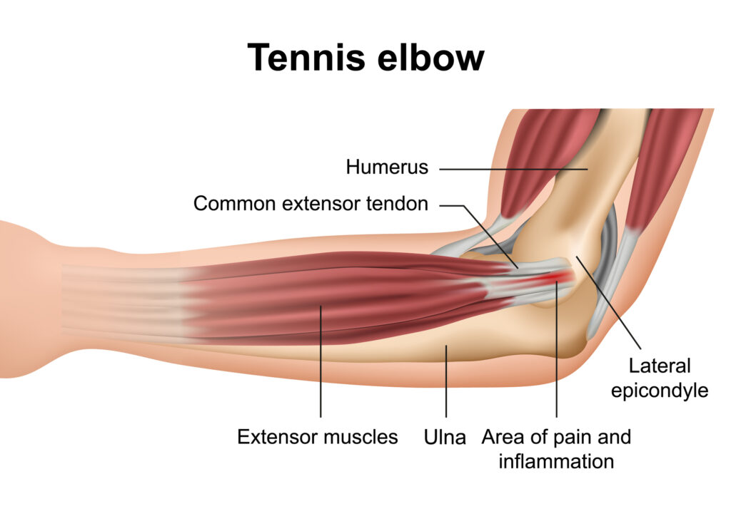 Tennis Elbow Treatment