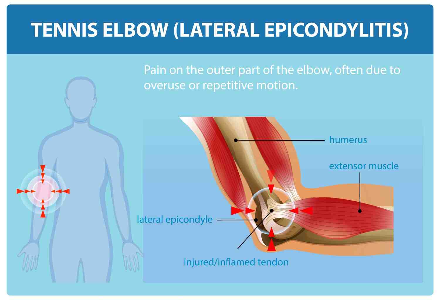Tennis Elbow Treatment by Dr. Jigar Desai